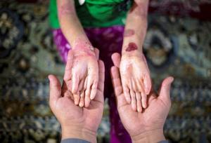 دولتی: مشاوره ژنتیک از تولد نوزادان بیمار پیشگیری می‌کند