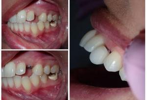 مراحل ایمپلنت دندان و مدت زمان انجام آن