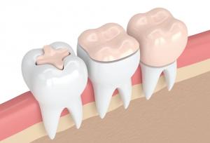 تفاوت اینله و انله دندان با پرکردگی معمولی چیست؟