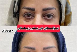 بهترین مرکز تزریق بوتاکس در تهران + معرفی ۱۰ دکتر و کلینیک برتر