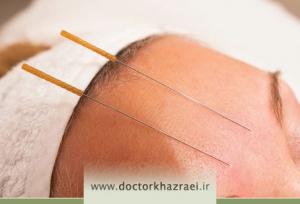 طب سوزنی برای میگرن؛ روشی طبیعی و بی‌عارضه برای کنترل سردردهای میگرنی