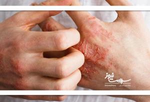 اگزمای شدید بی‌خوابی می‌آورد
