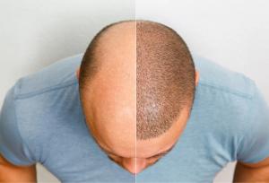 پی آر پی (PRP) بعد از کاشت مو چه فوایدی دارد؟