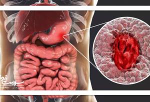 راهنمای غذایی برای بیماران مبتلا به سرطان معده پیشرفته