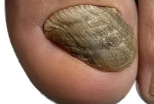 قارچ ناخن علائم، علت‌ها و پیشگیری در مرکز تخصصی پُدولانژ