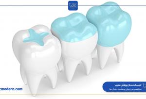 کلینیک مدرن مرکز تخصصی انجام اینلی و آنلی دندان در سراسر ایران