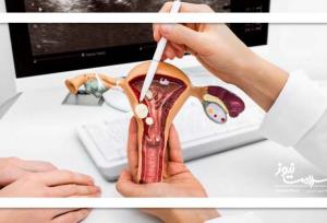 فیبروم رحمی و ارتباط آن با بیماری قلبی در زنان