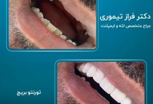 متخصص ایمپلنت با لیزر در کرج | ویژگی‌ها و چگونگی یافتن