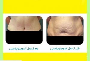 جراحی زیبایی شکم (عمل ابدومینوپلاستی) | مزایا، عوارض و هزینه