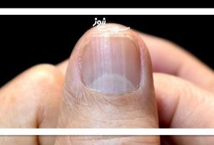 حقایقی درباره هاله ناخن‌ها