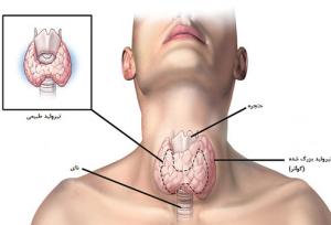 بهترین متخصص جراحی تیروئید در تهران را بشناسید+لیست ۱۰ متخصص برتر