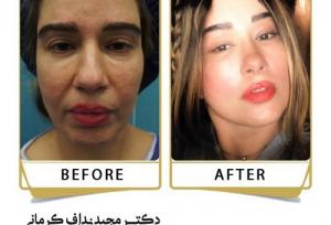 انواع لیفت صورت | بررسی روش‌های مختلف لیفت صورت + جدول مقایسه