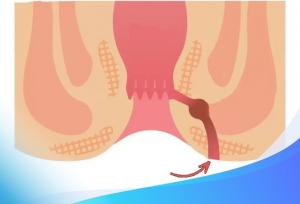 آیا فیستول مقعدی خطرناکه؟