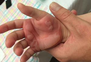 چرا سوختگی در کودکان به مراتب خطرناک‌تر از بزرگسالان است؟