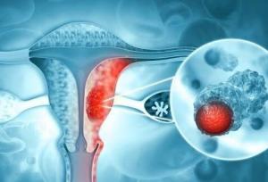 خونریزی غیرطبیعی، مهم‌ترین هشدار ابتلا به سرطان رحم