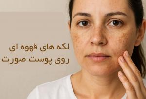 لکه های قهوه ای روی پوست صورت نشانه چیست؟
