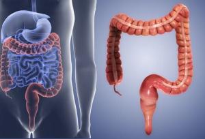 افزایش بیماری‌های التهابی روده در نسل جوان/ نقش کلیدی استرس و سبک زندگی