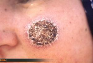 کاهش ۶۰ درصدی ابتلا به سالک در نطنز 