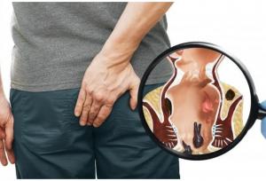 درمان فوری بواسیر، شقاق و فیستول بدون بیهوشی؛ روش‌های نوین ۱۴۰۴