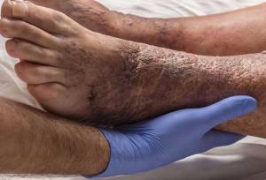 بی‌دردی زخم در افراد دیابتی نشانه پیشرفت آسیب عصبی است