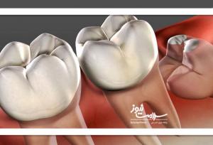 دندان عقل بی فایده یا ارزشمند؟