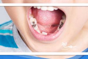 تبعات بی توجهی به سلامت دندان کودکان