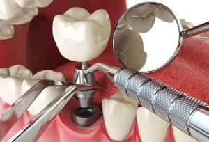 بهترین مرکز تخصصی ایمپلنت در کرج + لیست ۱۰ مرکز برتر