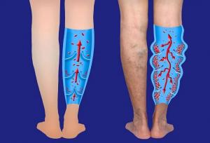 معرفی بهترین قرص‌ ها و پمادهای موثر در درمان واریس