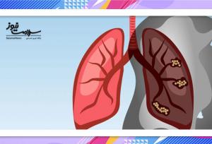 دلایل ابتلا به سرطان ریه در افراد غیرسیگاری