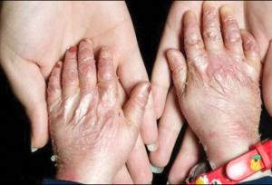 پانسمان حیاتی بیماران پروانه‌ای در فهرست تحریم‌هاست / هیچ کودک پروانه‌ای نباید از تحصیل بازبماند