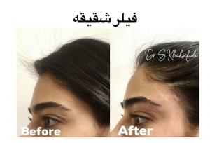 بهترین دکتر تزریق فیلر شقیقه کیست؟ + لیست ۱۰ پزشک برتر