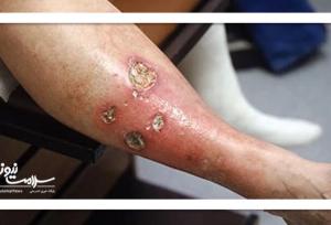 پیشگیری از زخم پای دیابتی؛ مراقبت‌های روزانه و معاینات منظم ضروری است