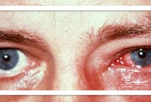 عوارض آلودگی هوا بر چشم