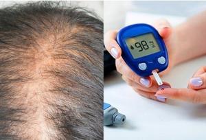 ارتباط دیابت با ریزش مو