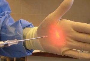 لیزر هموروئید؛ روشی قطعی و فوری