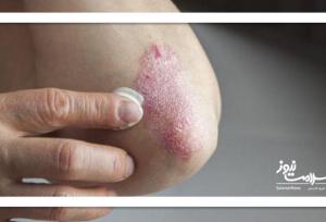 ۱۲ علت شایع پوسته‌پوسته شدن پوست