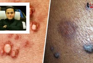 کشف داروی شگفت‌انگیز HPV توسط دانشمند ایرانی
