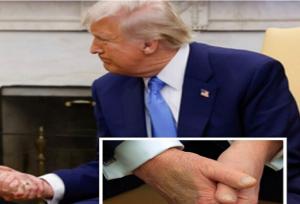 ابتلای ترامپ به «نارسایی مزمن وریدی»