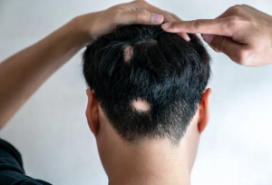 اگر در خطر ریزش مو هستید، از این هوش مصنوعی بپرسید!