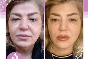 بهترین دستگاه هایفوتراپی سال ۱۴۰۴ | انواع برند، مزایا، کاربرد و عوارض