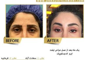 لیفت شقیقه چیست و چه روش‌هایی دارد؟