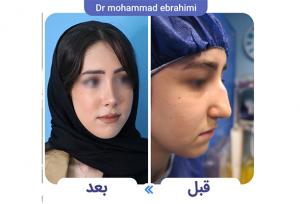 هزینه عمل جراحی بینی در سال ۱۴۰۴ + جدول قیمت
