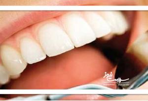 لبخند تقلبی به قیمت سلامت دندان