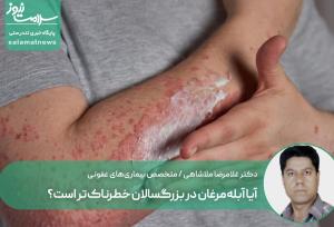 آیا آبله‌مرغان در بزرگسالان خطرناک‌تر است؟
