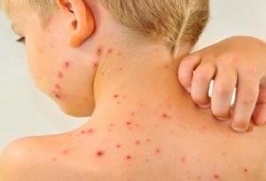 بالاترین میزان موارد ابتلا به سرخک در آمریکا از سال ۲۰۰۰ تاکنون
