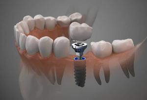 ایمپلنت دندان چیست؟ (بررسی کامل Dental Implant)