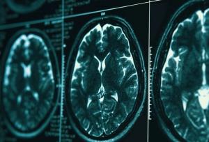 روشی در توقف بیماری آلزایمر کشف شد