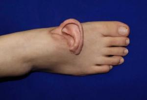 گوش برای اولین بار به پا پیوند زده شد