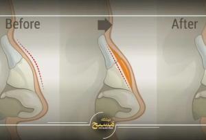 قیمت تیپ پلاستی بینی در تهران؛ بررسی تخصصی و عوامل تأثیرگذار