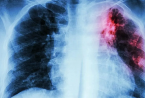 کشنده‌ترین بیماری عفونی جهان اعلام شد